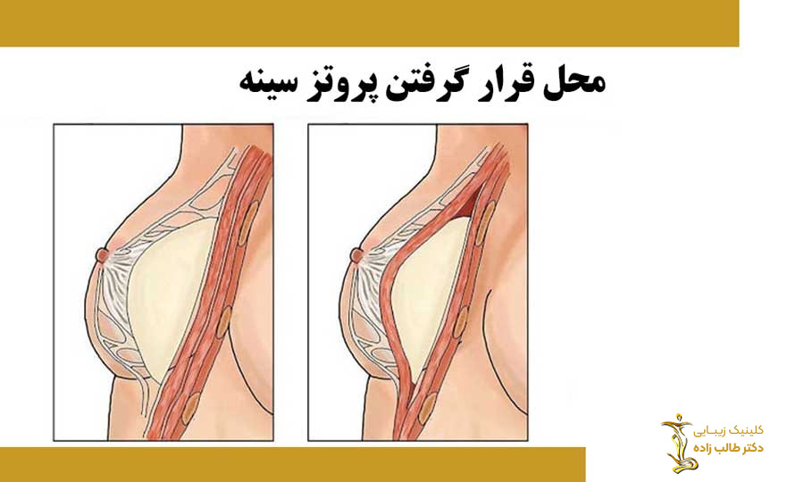 جراحی پروتز سینه در مشهد